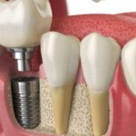 Dental Implants In Adelaide