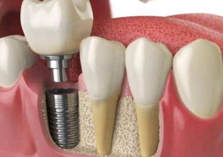 Dental Implants In Adelaide