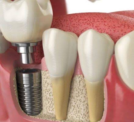 Dental Implants In Adelaide