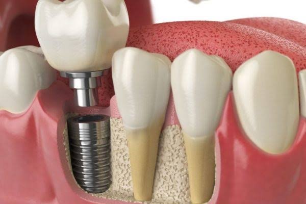 Dental Implants In Adelaide